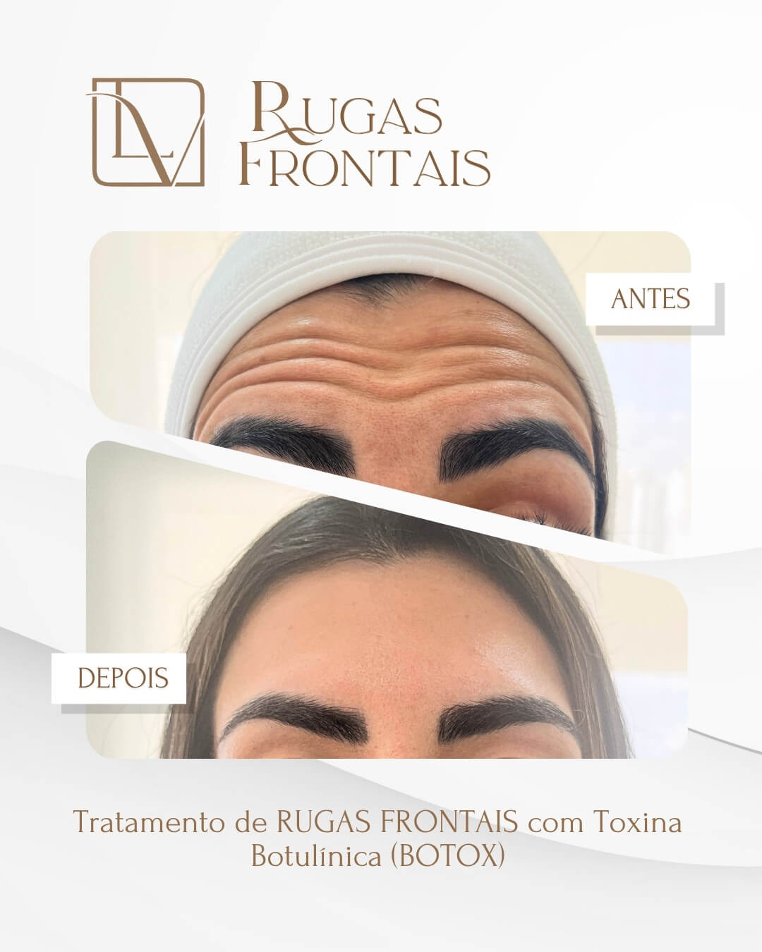 Segundo caso de rugas frontais antes e depois