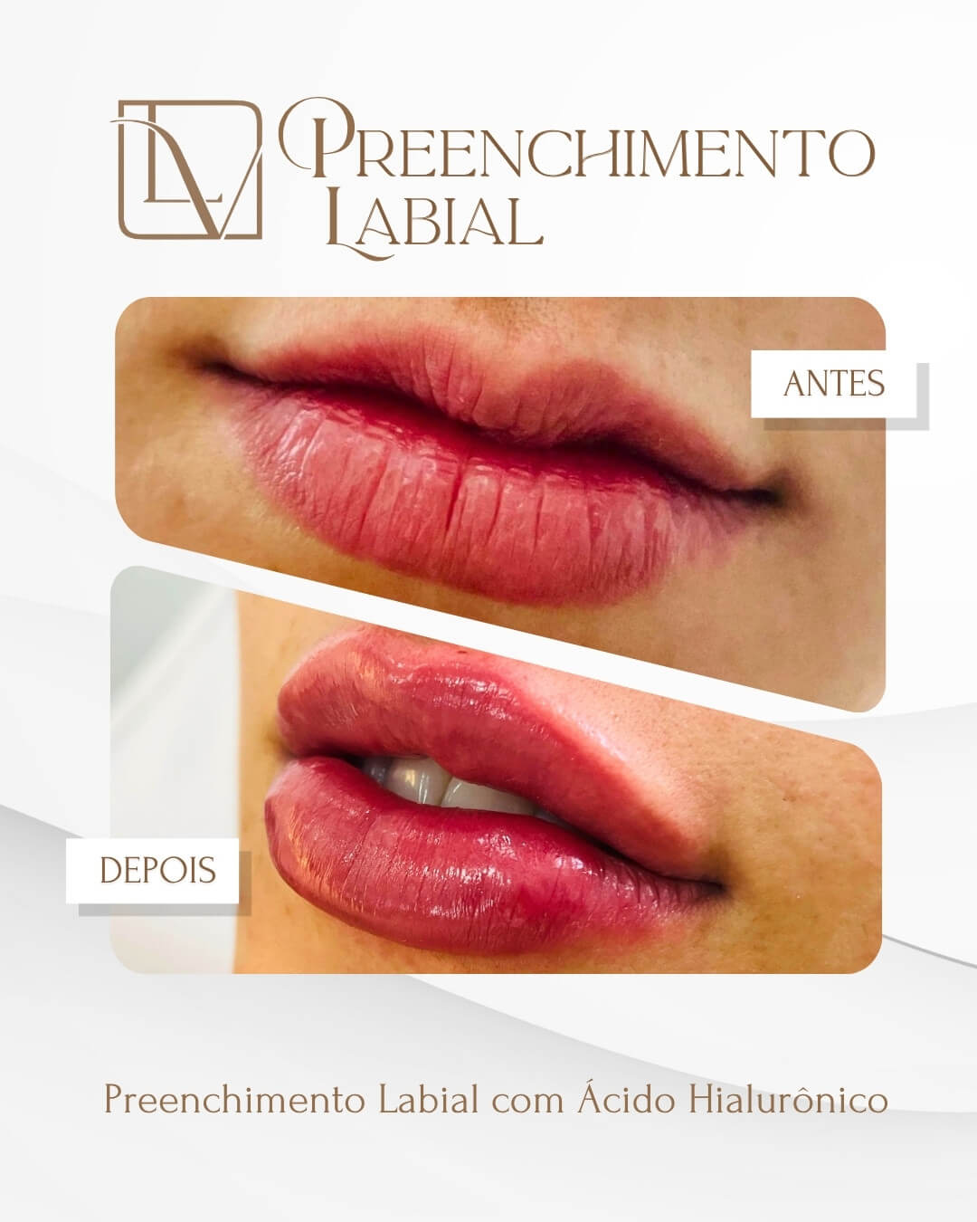 Resultado de preenchimento labial antes e depois
